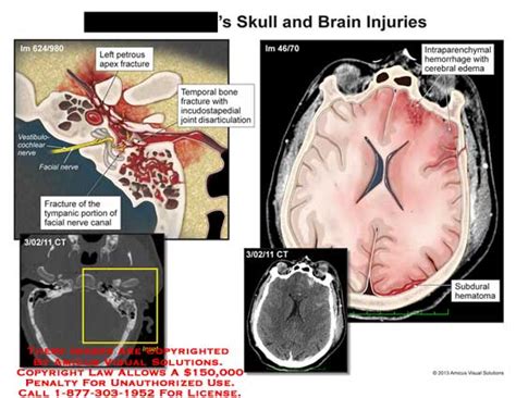 Amicus Illustration Of Amicus Injury Head Skull Brain Fracture Tympanic