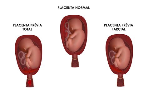 Placenta prévia o que é e quais são os riscos para gravidez Revista