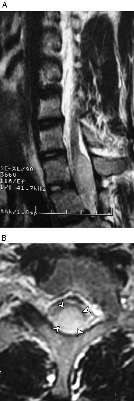 T 2 Weighted Sagittal A And Axial B Spinal Mri Show A Posteriorly