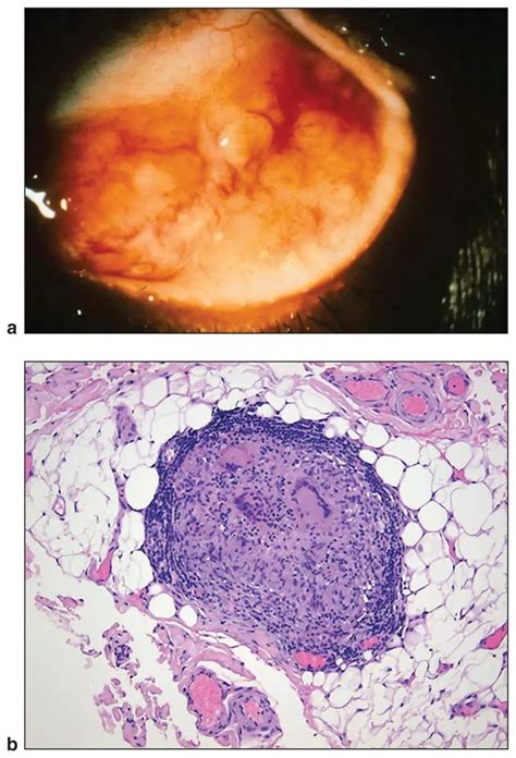 Ocular involvement in sarcoidosis - American Academy of Ophthalmology