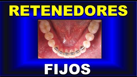 Retenedores Fijos Tipos Ventajas Indicaciones De Mantenedores De