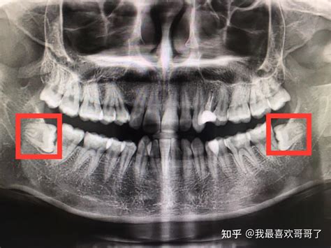 华西口腔拔智齿多少钱 知乎