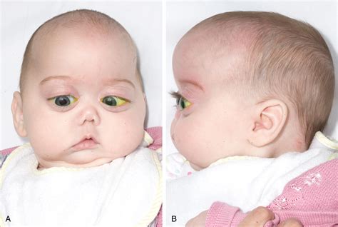 Cleft Palate And Velopharyngeal Dysfunction Clinical Tree