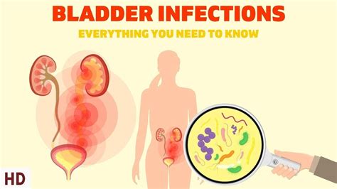 Bladder Infections The Silent Epidemic Affecting Millions Of Women