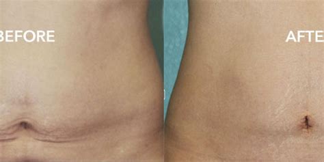 Smart Lipo Really Smart Remove The Fat Tighten The Skin Dr Zadeh Cosmetics