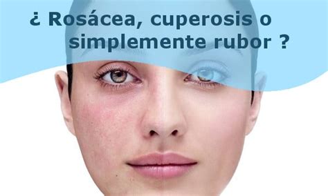 Rojeces En La Cara Cuperosis Y Rosácea Prevención Y Tratamientos