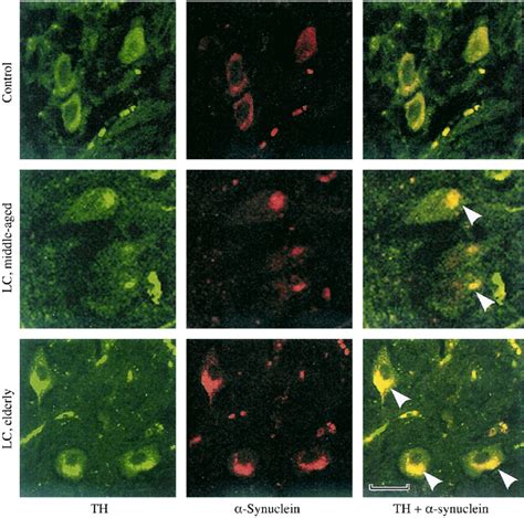 Localization of α synuclein aggregates in dopaminergic neurons in the