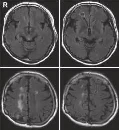 Magnetic resonance images showing white matter lesions near the right...