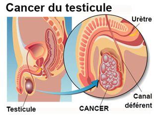 Cancer Testicule Le Blog NutriformLab