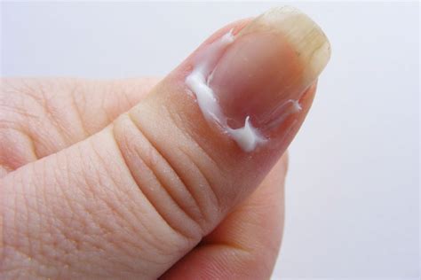 How To Take Care of Painful Dry Cuticles? | hergamut