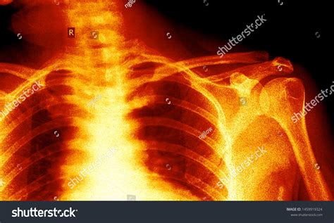 Shoulder X Ray Anatomy Radiology Radiographic Stock Photo 1459919324 | Shutterstock