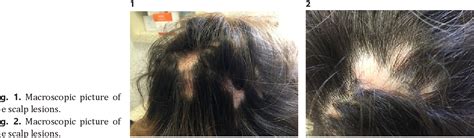 Figure 1 From Secondary Alopecia Neoplastica Mimicking Alopecia Areata