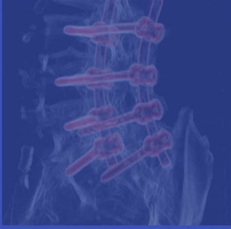 Corpectom A Cervical Anterior Reconstrucci N Jos Vicente Moll Torr