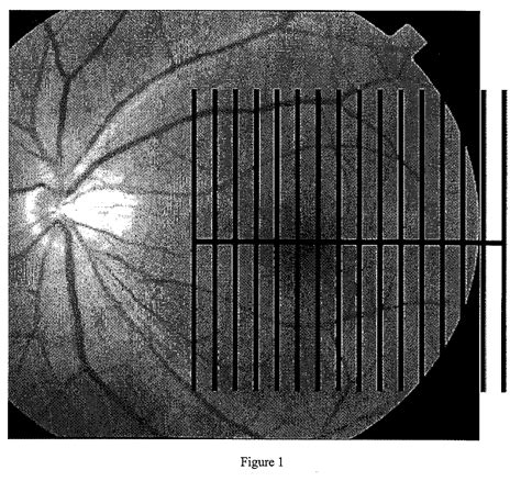 Retrobulbar optic nerve patented technology retrieval search results - Eureka | Patsnap