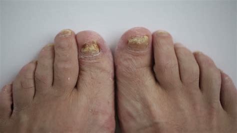 Trauma Of Toenail Subungual Hematoma Bruise Under The Nail Of Big Toe