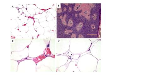 Subcutaneous Adipose Tissue Diseases Dercum Disease Lipedema