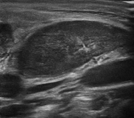 Head and Neck | 4.4 Lymph nodes : Case 4.4.1 Benign lymph nodes ...