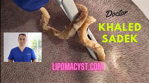 Massive Pilar Cyst Dr Khaled Sadek YouTube