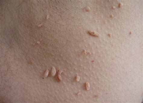 What Causes Skin Tags? | Healthcare-Online