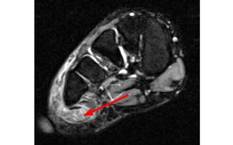 Baxter S Nerve Entrapment Diagnosis Treatment Injection Surgery