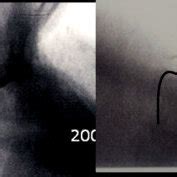 A B Shows Fluoroscopic Stored Images During The Procedure Which