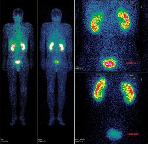 Renal Scintigraphy Medical Diagnosis