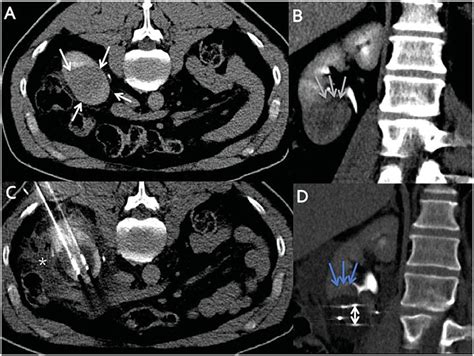 A Axial Contrast Enhanced Computed Tomography Ct Image Of A T1b