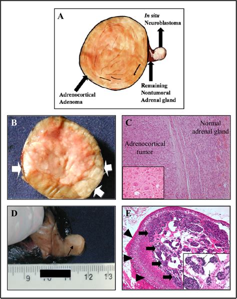 Morphological And Histological Characterization Of Tumors From Patient