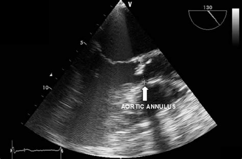 Aortic annulus measurement by the transesophageal echocardiography. It ...