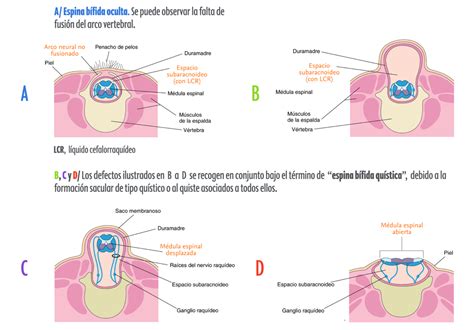 Espina bífida Nepsa Rehabilitación Neurológica