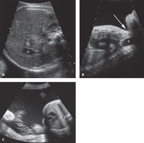 Tracheoesophageal Fistula Ultrasound