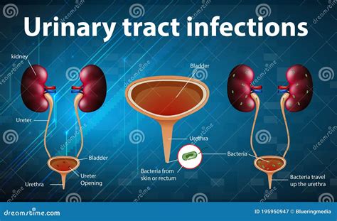 Ilustración Informativa De Infecciones Del Tracto Urinario Stock De Ilustración Ilustración De