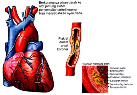 Jurnal Penyakit Jantung Koroner Homecare24