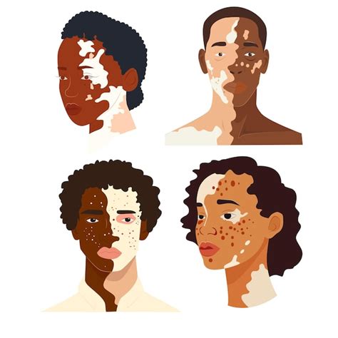 Vitiligo people Illustration vectorielle plate Le concept de beauté