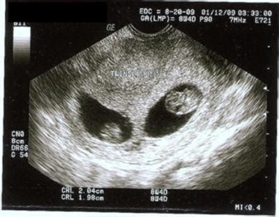 8 Weeks 4 Days Twins Ultrasound