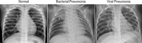 Pneumonia Diagnosis using Deep Learning | by Richard Han | Towards Data ...