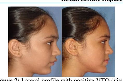 Figure 2 From Treatment Of Class II Malocclusion With Combined Twin