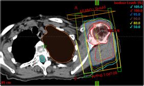 An Introduction To Low Dose Radiation Therapy For Shoulder