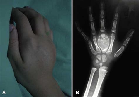 Quiste óseo Aneurismático En Tercer Metacarpiano Tratado Con Injerto No