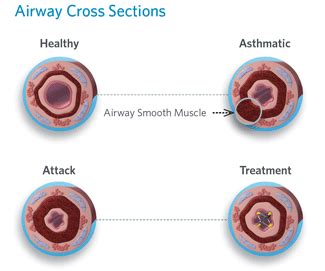 Bronchial Thermoplasty Services Mary Parkes Asthma Center