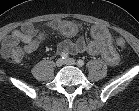 Small Bowel | Radiology Key