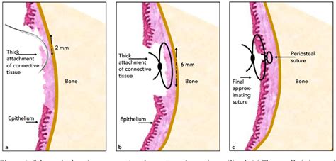 Figure 2 From A Modified Approach In Lip Repositioning Surgery For