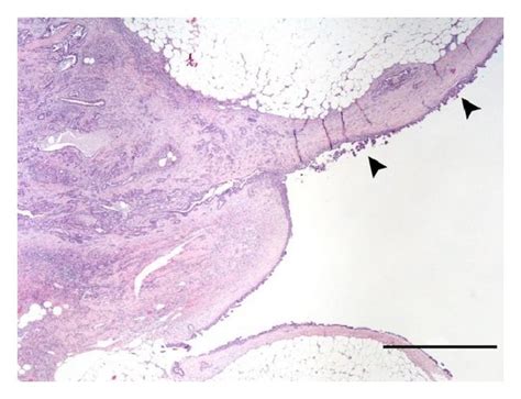 A Prostate Gland Prostatic Adenocarcinoma Note The Neoplastic Cells Download Scientific