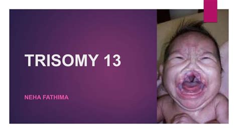 Trisomy 13 | PPT