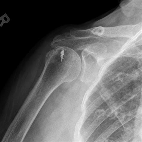 Dr Mcclintocks Shoulder X Ray Image Gallery Kyle Mcclintock Do Orthopedic Surgeon