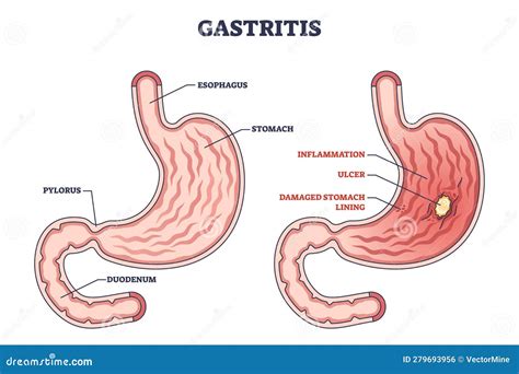 Gastritis As Stomach Lining Inflammation Illness And Disease Outline