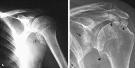 Synovial osteochondromatosis causes, symptoms, diagnosis, treatment ...