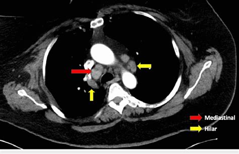 CT scan of the chest revealed mediastinal and hilar lymphadenopathy... | Download Scientific Diagram