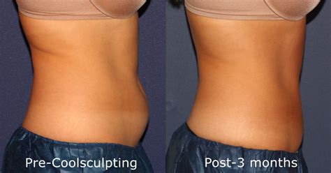 Coolsculpting San Diego Ca Cosmetic Laser Dermatology