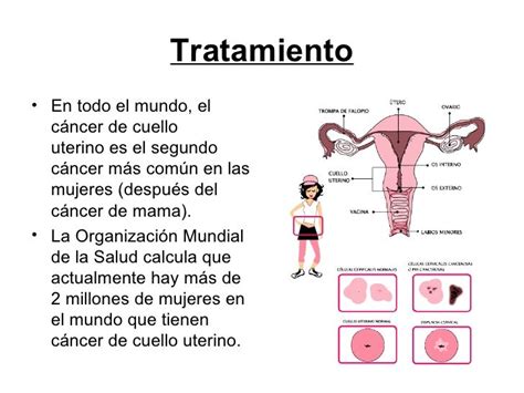 Qué Es El Cáncer De Cuello Uterino